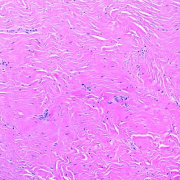 Key Desmoid Tumor Diagnostic Strategies - Springworks